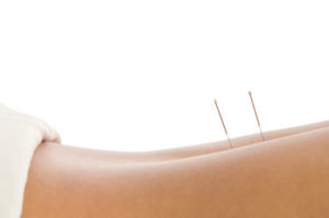 acupuncture of back